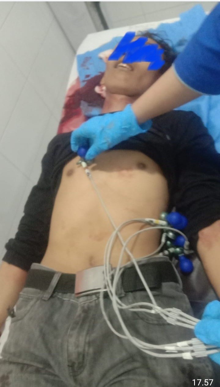 Medan.   | Aksi tawuran berujung dengan korban jiwa, pecah dikawasan Gang Tawon Lingkungan 14  Kelurahan Tanjung Mulia Kecamatan Medan Deli, Jumat dini hari (02/05/2025) pukul 02:00 WIB. Dua kubu kelompok remaja itu saling serang dengan mengunakan berbagai jenis senjata tajam, hingga akhirnya remaja berinisial P (18) warga KL Yos Sudarso Kelurahan Tanjung Mulia Kecamatan Medan Deli tewas dengan luka dibagian kepala belakang akibat dihantam senjata tajam. Kapolsek Medan Labuhan Kompol Tohap Sibuea ketika dikonfirmasi wartawan, Jumat malam (2/4) pukul 19:20 WIB, membenarkan adanya aksi tawuran di wilayah hukumnya tersebut. "Iya sudah ada 8 orang yang diamankan dengan berbagai jenis senjata tajam, rata-rata mereka masih berusia dibawah umur dan kini masih dilakukan pemeriksaan lebih lanjut, " ucapnya saat ditemui wartawan di SPKT Polsek Medan Labuhan. Informasi yang berhasil dihimpun wartawan menyebutkan, korban sempat dibawah oleh rekan-rekannya ke RS Mitra Medika di kawasan Jalan KL Yos Sudarso namun diduga akibat lukanya korban meninggal dunia. *toga# Korban tawuran.
